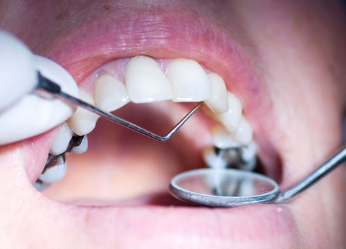 Teeth Fillings