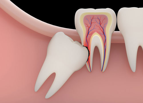 Teeth Removal/Extraction